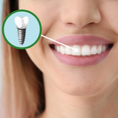 Dental Implants in Istanbul in Turkey