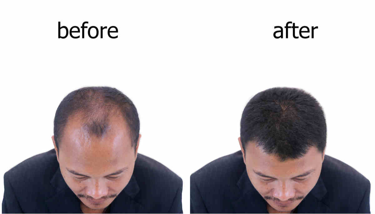 Фотографии пересадки волос до и после