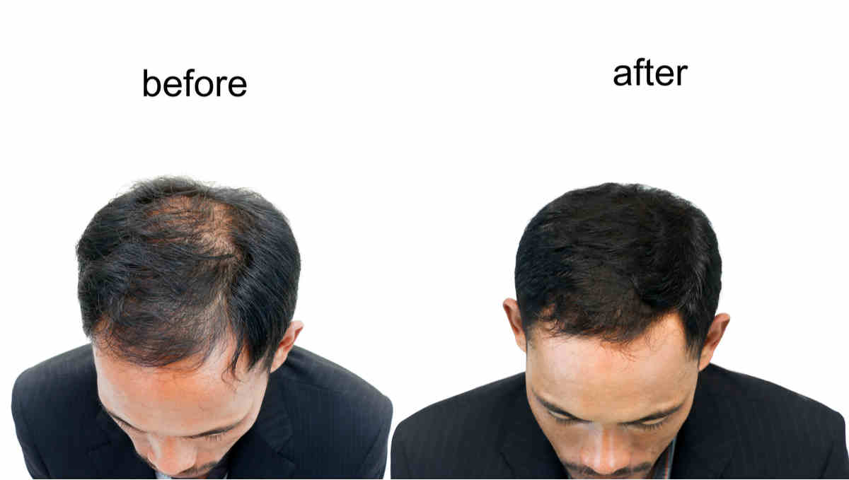 Hair Transplant Before and After Pictures