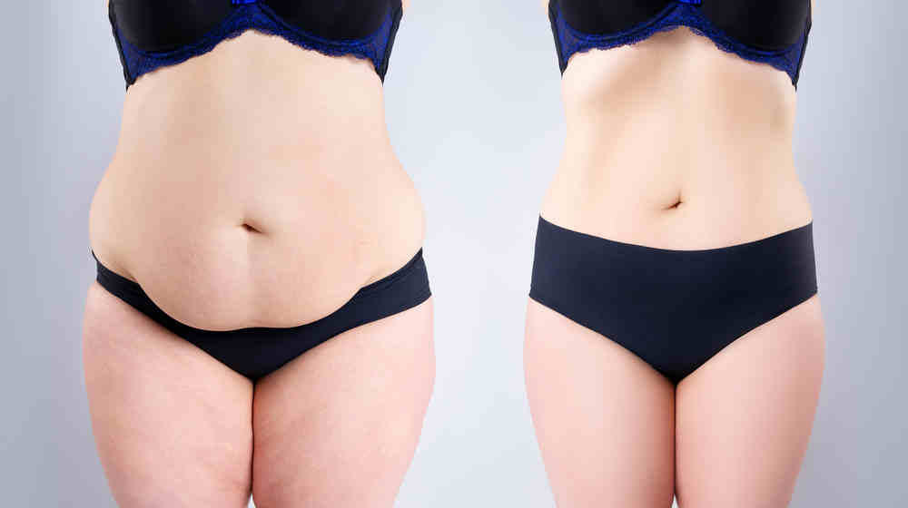 LIPOSUCTION BEFORE AND AFTER PICTURES-2