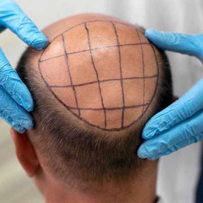 haartransplantation